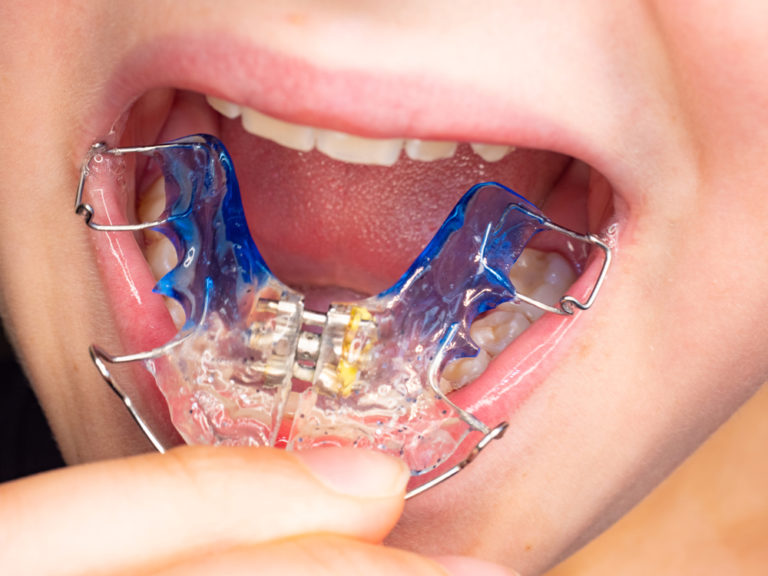What is an Orthodontic Expander & When is it Necessary? The Brace Place