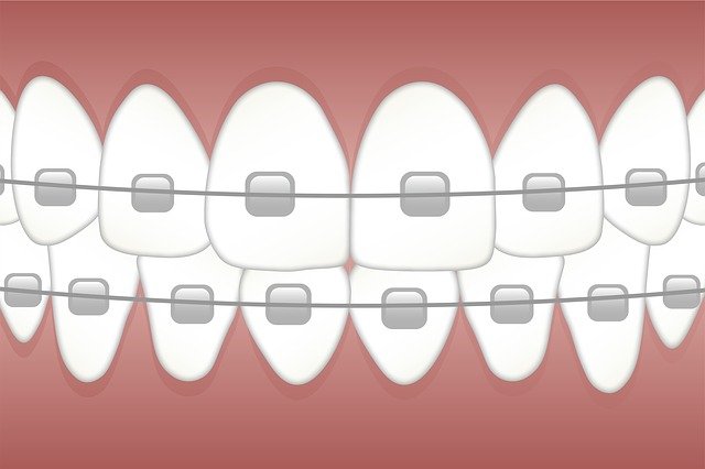 how to get your braces off faster