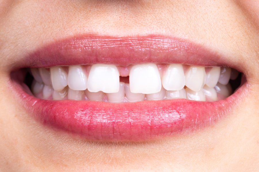 what is diastema