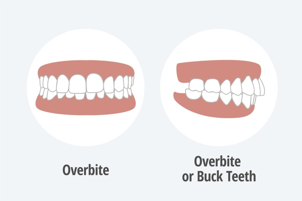 Illustrations of teeth with overbite and buck teeth