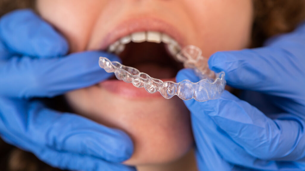Straightening Your Teeth With Online Clear Aligners vs. Invisalign