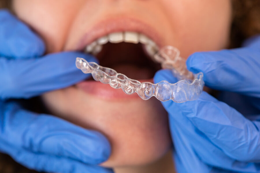 Online Clear Aligners vs. Invisalign